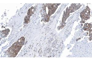 IHC-P Image Immunohistochemical analysis of paraffin-embedded human ovarian cancer, using GLO1, antibody at 1:100 dilution. (GLO1 anticorps)