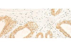 Immunohistochemistry of paraffin-embedded Human breast cancer tissue using IFI35 Polyclonal Antibody at dilution of 1:35(x200) (IFI35 anticorps)