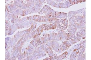 IHC-P Image Immunohistochemical analysis of paraffin-embedded human colon carcinoma, using Casein Kinase 1 alpha 1L, antibody at 1:500 dilution. (CSNK1A1L anticorps)
