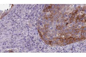 ABIN6275176 at 1/100 staining Human urothelial cancer tissue by IHC-P.