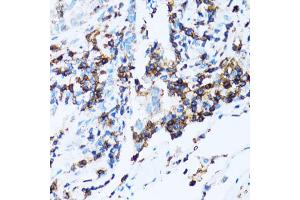Immunohistochemistry of paraffin-embedded human lung cancer using SPN antibody (ABIN5973813) at dilution of 1/100 (40x lens). (CD43 anticorps)