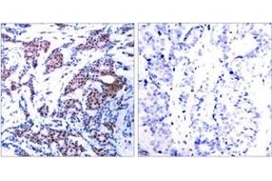 Immunohistochemistry analysis of paraffin-embedded human breast carcinoma, using c-Jun (Phospho-Ser73) Antibody. (C-JUN anticorps  (AA 40-89))