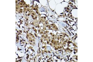 Immunohistochemistry of paraffin-embedded human breast cancer using [KO Validated] ST Rabbit mAb (ABIN7270305) at dilution of 1:100 (40x lens).