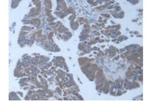 IHC-P analysis of Human Liver Cancer Tissue, with DAB staining. (POFUT1 anticorps  (AA 238-388))
