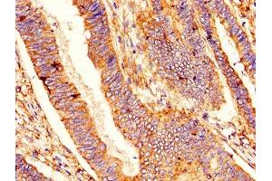 IHC image of ABIN7145294 diluted at 1:400 and staining in paraffin-embedded human colon cancer performed on a Leica BondTM system.