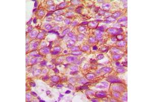 Immunohistochemical analysis of ECHOS1 staining in human breast cancer formalin fixed paraffin embedded tissue section.