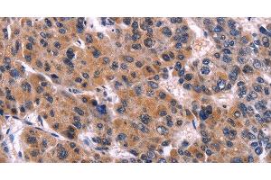 Immunohistochemistry of paraffin-embedded Human liver cancer tissue using EIF2AK4 Polyclonal Antibody at dilution 1:50 (GCN2 anticorps)
