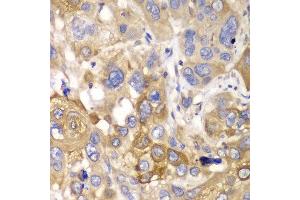 Immunohistochemistry of paraffin-embedded human esophageal cancer using PPP1CB antibody at dilution of 1:100 (400x lens).