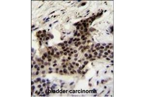 UBXN2A Antibody (C-term) (ABIN655308 and ABIN2844890) immunohistochemistry analysis in formalin fixed and paraffin embedded human bladder carcinoma followed by peroxidase conjugation of the secondary antibody and DAB staining. (UBXN2A anticorps  (C-Term))