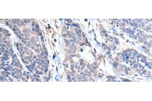 Immunohistochemistry of paraffin-embedded Human thyroid cancer tissue using TRIM27 Polyclonal Antibody at dilution of 1:65(x200) (TRIM27 anticorps)