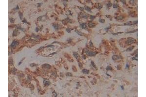 Detection of FADD in Human Lung cancer Tissue using Polyclonal Antibody to Fas Associating Death Domain Containing Protein (FADD)