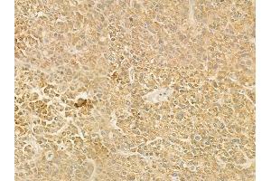 ABIN6263787 and ABIN6278498 at 1/100 staining human hepatocellular carcinoma by IHC-P.
