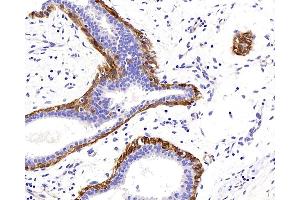 Immunohistochemistry analysis of paraffin-embedded human breast cancer using TAGLN Polyclonal Antibody at dilution of 1:400. (Transgelin anticorps)
