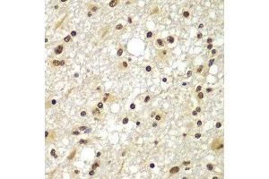 Immunohistochemistry of paraffin-embedded human brain cancer using ZNF20 antibody at dilution of 1:100 (x400 lens). (ZNF20 anticorps)