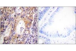 Immunohistochemistry analysis of paraffin-embedded human colon carcinoma, using c-Met (Phospho-Tyr1003) Antibody.
