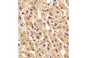(ABIN6242565 and ABIN6578213) staining PGM1 in human liver tissue sections by Immunohistochemistry (IHC-P - paraformaldehyde-fixed, paraffin-embedded sections). (Phosphoglucomutase 1 anticorps  (AA 469-501))