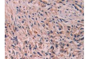 DAB staining on IHC-P;;Samples: Human Prostate cancer Tissue (IL-24 anticorps  (AA 51-206))