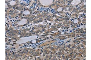 The image on the left is immunohistochemistry of paraffin-embedded Human thyroid cancer tissue using ABIN7191523(MT-ND3 Antibody) at dilution 1/30, on the right is treated with synthetic peptide. (MT-ND3 anticorps)