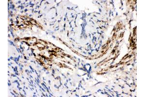 Anti- MAOB Picoband antibody,IHC(P) IHC(P): Human Lung Cancer Tissue