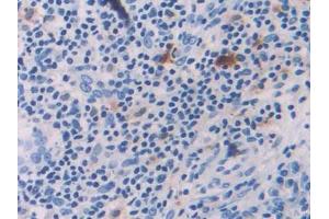 DAB staining on IHC-P; Samples: Human Skin cancer Tissue (IL-18 anticorps  (AA 37-193))