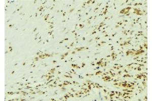 ABIN6269139 at 1/100 staining Human breast cancer tissue by IHC-P. (Src anticorps)