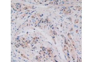 Used in DAB staining on fromalin fixed paraffin- embedded prostate gland cancer tissue (ALOX15B anticorps  (AA 253-490))