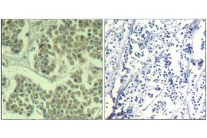 Immunohistochemical analysis of paraffin-embedded human breast carcinoma tissue using eIF2α (Phospho-Ser49) Antibody (left) or the same antibody preincubated with blocking peptide (right). (EIF2S1 anticorps  (pSer49))