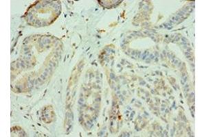 Immunohistochemistry of paraffin-embedded human breast cancer using ABIN7156335 at dilution of 1:100 (IRS1 anticorps  (AA 1-160))