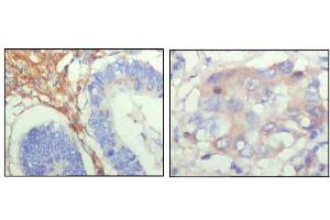 Immunohistochemical analysis of paraffin-embedded human colon cancer (left) and breast cancer (right) showing cytoplasmic localization with DAB staining using FBLN5 mouse mAb. (Fibulin 5 anticorps)