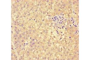 Immunohistochemistry of paraffin-embedded human liver cancer using ABIN7163147 at dilution of 1:100