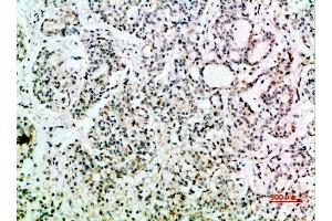 Immunohistochemical analysis of paraffin-embedded human-stomach-cancer, antibody was diluted at 1:200. (EGF anticorps  (AA 1000-1060))