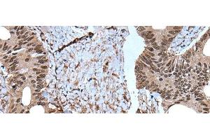 Immunohistochemistry of paraffin-embedded Human colorectal cancer tissue using ZNF787 Polyclonal Antibody at dilution of 1:45(x200) (ZNF787 anticorps)