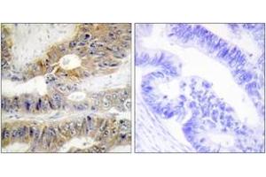 Immunohistochemistry analysis of paraffin-embedded human colon carcinoma tissue, using TNFRSF6B Antibody.