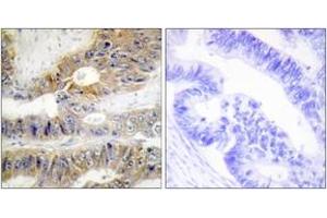 Immunohistochemistry analysis of paraffin-embedded human colon carcinoma tissue, using TNFRSF6B Antibody. (TNFRSF6B anticorps  (AA 251-300))