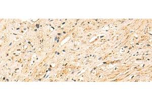 Immunohistochemistry of paraffin-embedded Human prost at e cancer tissue using EEF1AKMT2 Polyclonal Antibody at dilution of 1:50(x200)