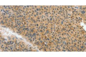 Immunohistochemistry of paraffin-embedded Human liver cancer tissue using ACLY Polyclonal Antibody at dilution 1:40