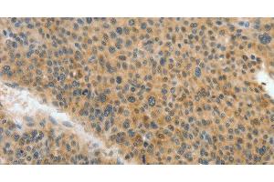 Immunohistochemistry of paraffin-embedded Human liver cancer tissue using ACLY Polyclonal Antibody at dilution 1:40 (ACLY anticorps)