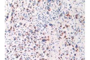 IHC-P analysis of Human Stomach Cancer Tissue, with DAB staining. (HSPD1 anticorps  (AA 172-343))