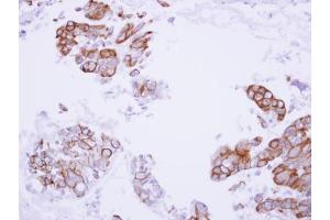 IHC-P Image Immunohistochemical analysis of paraffin-embedded human lung adenocarcinoma, using MASPIN, antibody at 1:100 dilution. (SERPINB5 anticorps  (Center))