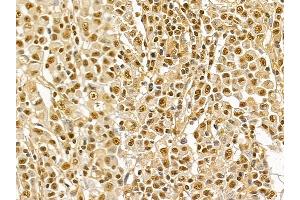 NRF1 Mouse Monoclonal Antibody at 1/100 staining human gastric cancer by IHC-P. (NRF1 anticorps  (Internal Region))