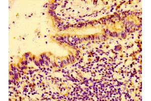 Immunohistochemistry of paraffin-embedded human lung cancer using ABIN7148441 at dilution of 1:100 (CTGF anticorps  (AA 253-349))
