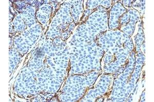 Formalin-fixed, paraffin-embedded human melanoma stained with NGF Receptor antibody (SPM299).