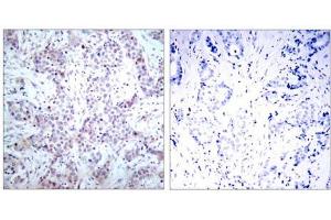 Immunohistochemical analysis of paraffin-embedded human breast carcinoma tissue using NF-κB p65 (Ab-536) antibody (E021014). (NF-kB p65 anticorps)