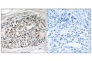 Immunohistochemistry analysis of paraffin-embedded human breast carcinoma tissue using EHHADH antibody. (EHHADH anticorps  (Internal Region))