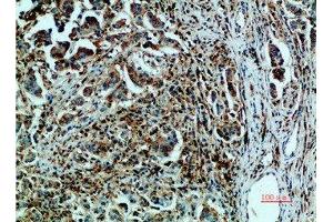 Immunohistochemical analysis of paraffin-embedded human-breast-cancer, antibody was diluted at 1:200