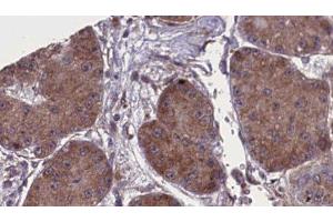 ABIN6277805 at 1/100 staining Human liver cancer tissue by IHC-P. (NCR1 anticorps  (Internal Region))