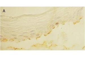 Immunohistochemistry image of Laminin 5 staining in cryosection of bullous pemphigoid Skin. (Laminin 5 anticorps)