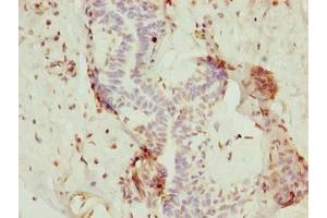 Immunohistochemistry of paraffin-embedded human breast cancer using ABIN7154806 at dilution of 1:100 (Nop10 anticorps  (AA 1-64))