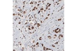 Immunohistochemical staining (Formalin-fixed paraffin-embedded sections) of human breast cancer with ARID1A monoclonal antibody, clone CL3595  shows moderate to strong nuclear immunoreactivity in tumor cells. (ARID1A anticorps)