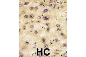 Formalin-fixed and paraffin-embedded human hepatocellular carcinoma tissue reacted with PROX1 polyclonal antibody , which was peroxidase-conjugated to the secondary antibody, followed by DAB staining. (PROX1 anticorps  (Internal Region))